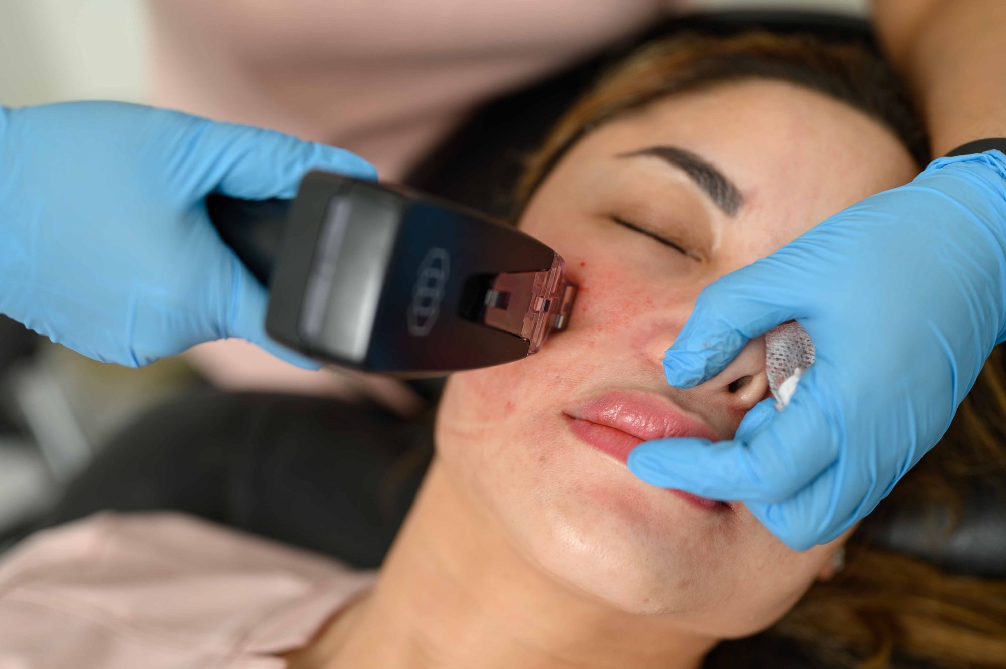 How Does Morpheus8 for Wrinkles Reduce Fine Lines Fast?