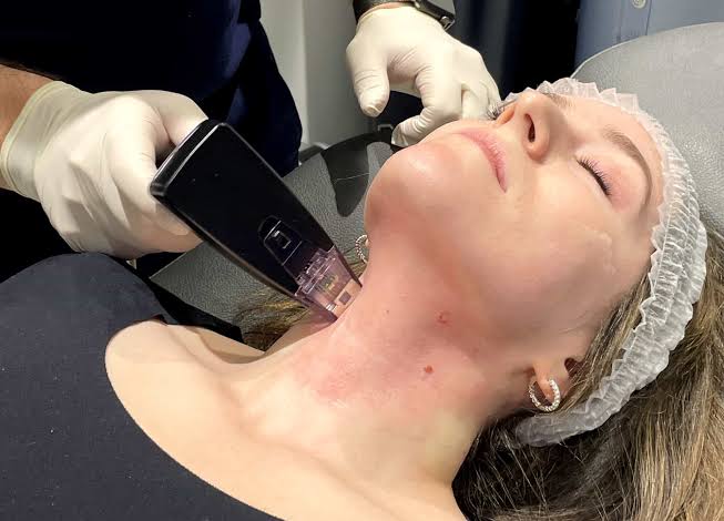 Is Morpheus8 Right for Today's Skin Care Needs?